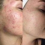 آموزش خدمات فیشال پوست فروزان خواجوی در اهواز