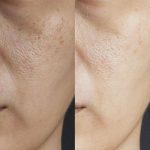 آموزش خدمات فیشال پوست فروزان خواجوی در اهواز