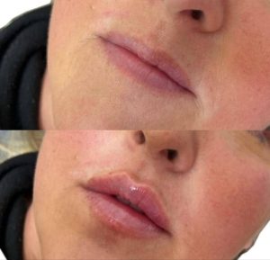 تزریق ژل لب کلینیک زیبایی زیمارخ در تهران در مشاغل ممتاز