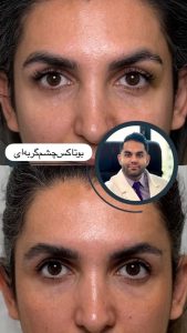 معرفی خدمات انواع مدل تزریق بوتاکس مرکز زیبایی لوتس در مشاغل ممتاز