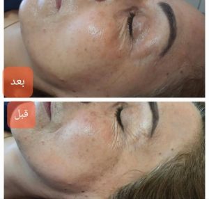 درمان کک و مک کلینیک زیبایی ندا بیگی در مشاغل ممتاز