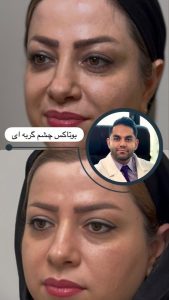 معرفی خدمات بوتاکس چشم گربه ای کلینیک لوتس در مشاغل ممتاز