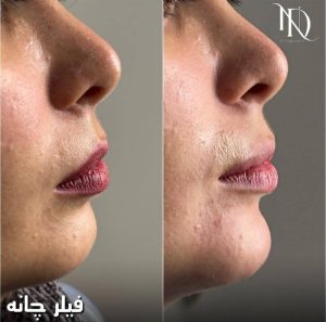 تزریق فیلر چانه کلینیک زیبایی رایا در اراک مشاغل ممتاز