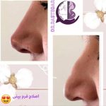 رفع گودی بغل ران کلینیک بنیتا در شرق تهران