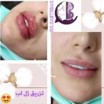 رفع گودی بغل ران کلینیک بنیتا در شرق تهران