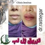 رفع گودی بغل ران کلینیک بنیتا در شرق تهران