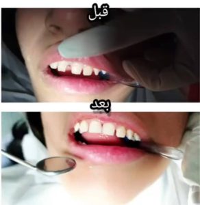 ترمیم و پر کردن دندان با مواد باکیفیت در کلینیک دندانپزشکی روشا کمالشهر_مشاغل ممتاز