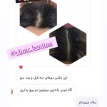 پر کردن هیپ دیپ کلینیک بنیتا در شرق تهران