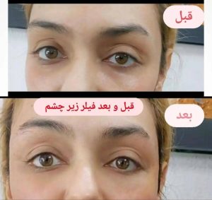 خدمات فیلر زیر چشم کلینیک بنیتا در تهران در مشاغل ممتاز