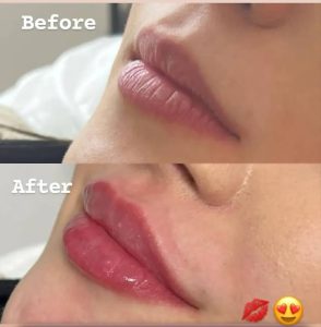 خدمات فیلر لب تخصصی در مرکز صدف-مشاغل ممتاز