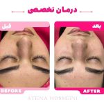 آموزش خدمات پاکسازی پوست آتنا حسینی در تهران