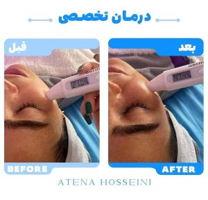 مواد و ماسک‌های تخصصی پاکسازی پوست در آموزشگاه آتنا حسینی-مشاغل ممتاز