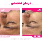 آموزش خدمات پاکسازی پوست آتنا حسینی در تهران