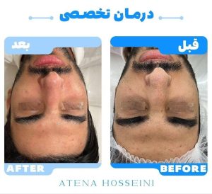 آموزش پاکسازی پوست در دوره‌های تخصصی آتنا حسینی تهران-مشاغل ممتاز