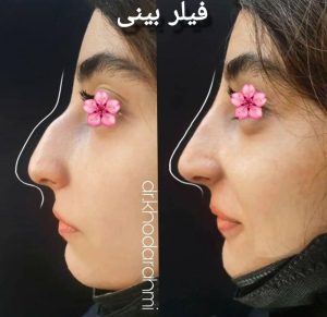 فیلر بینی تخصصی دکتر حمیدرضا خدارحمی تهران - مشاغل ممتاز