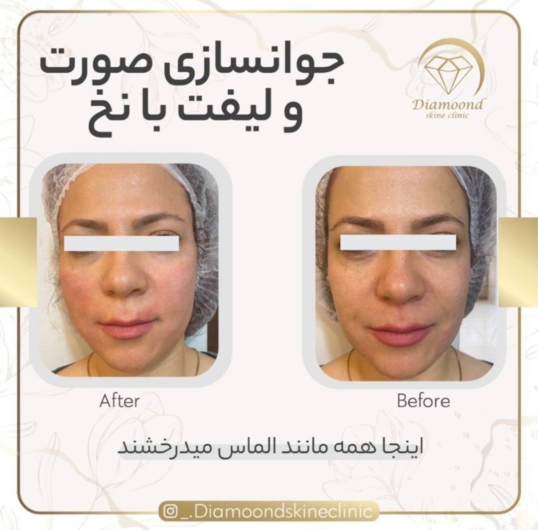 جوانسازی و شادابی پوست با روش‌های نوین در کلینیک زیبایی دایموند در شیراز_مشاغل ممتاز