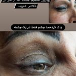 خدمات پیلینگ کربن مریم اسماعیلیان در اصفهان
