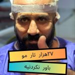 کاشت ابرو و مو سلطانی در شیراز