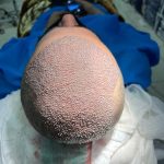 کاشت ابرو و مو سلطانی در شیراز