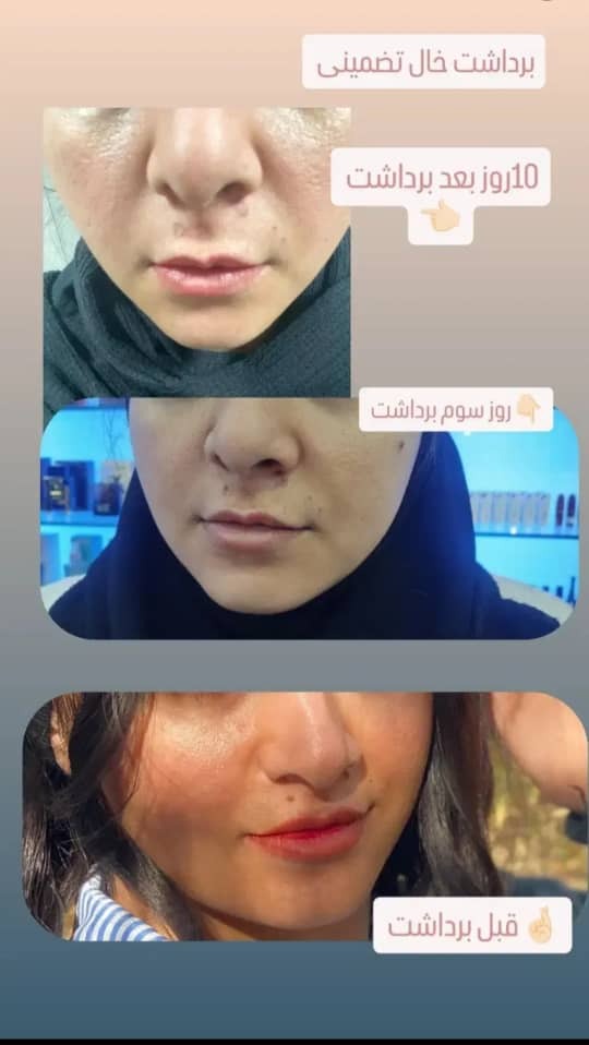 حذف سریع و ایمن زوائد پوستی با خدمات خالبرداری گیاهی دائمی در بجنورد-مشاغل ممتاز