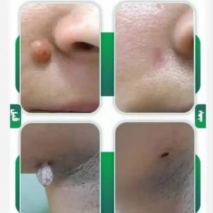تصویر قبل و بعد از خدمات خالبرداری گیاهی دائمی در بجنورد برای خال‌های گوشتی-مشاغل ممتاز