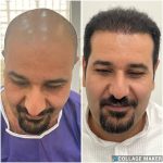 مرکز کاشت مو آتیه یزد