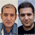 مرکز کاشت مو آتیه یزد