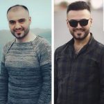 مرکز کاشت مو آتیه یزد