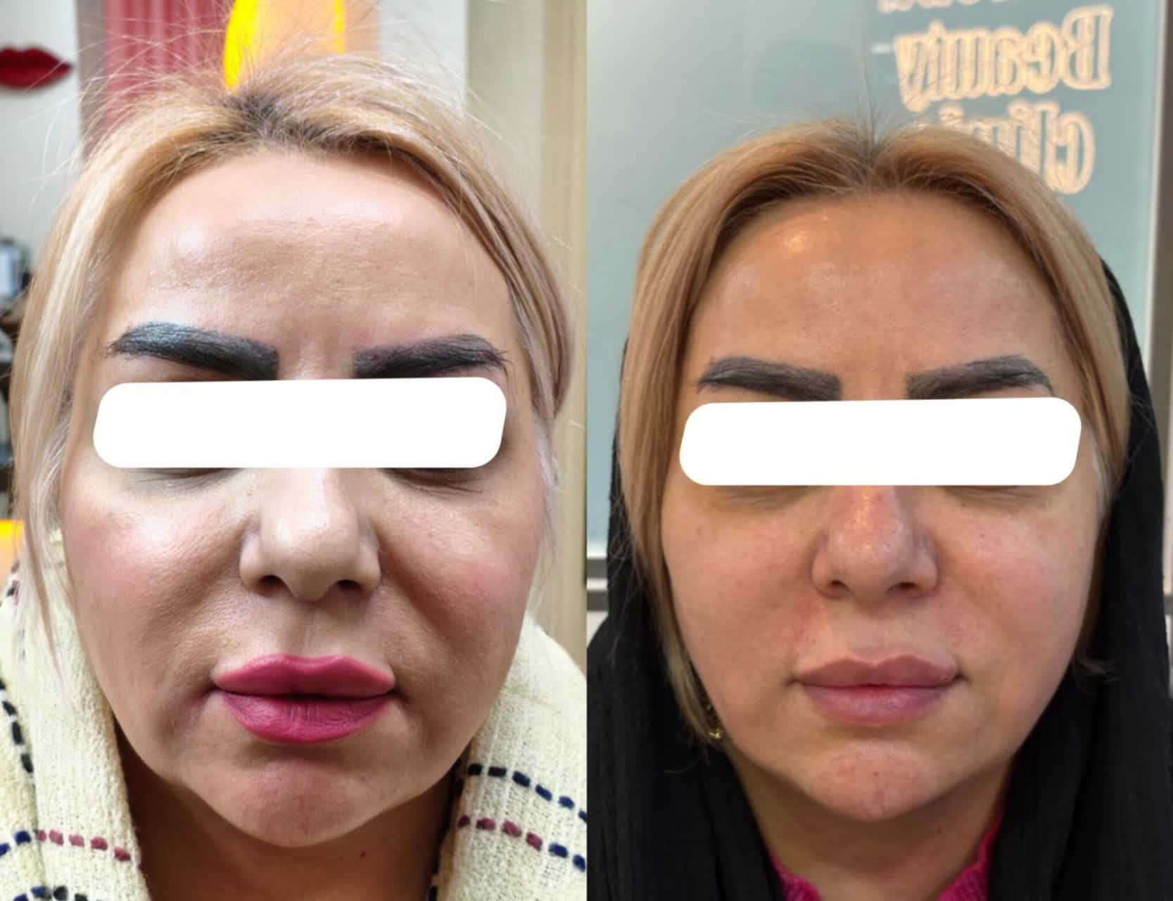 قبل و بعد جوانسازی مرکز زیبایی کهربا شهرری | مشاغل ممتاز