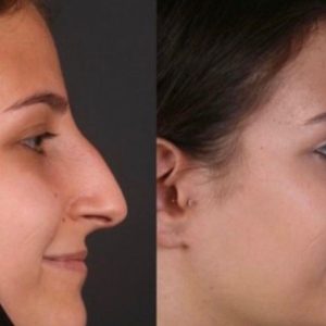 نمونه کار قبل و بعد از عمل بینی در بابل توسط دکتر علی‌جانپور متخصص ENT -مشاغل ممتاز