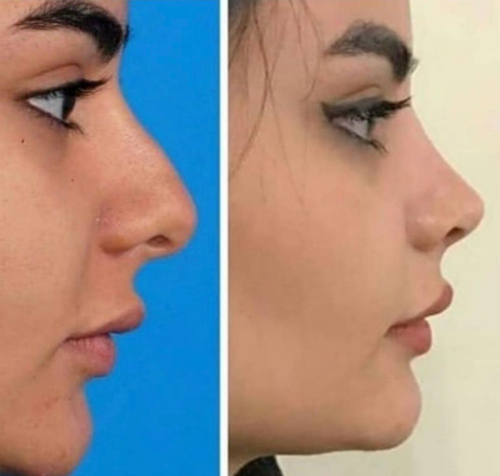 جراحی زیبایی بینی دکتر ابولحسن علی جانپور در بابل-مشاغل ممتاز