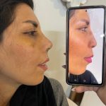 جراحی زیبایی بینی دکتر ابولحسن علی جانپور در بابل