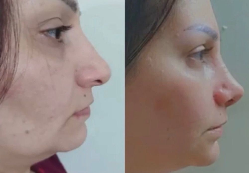 جراحی بینی گوشتی و استخوانی در بابل با فرم‌دهی دقیق و تنفس سالم -مشاغل ممتاز
