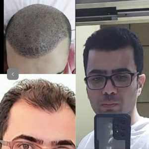 نتیجه کاشت مو طبیعی در کلینیک زیبایی وانیل سنندج-مشاغل ممتاز