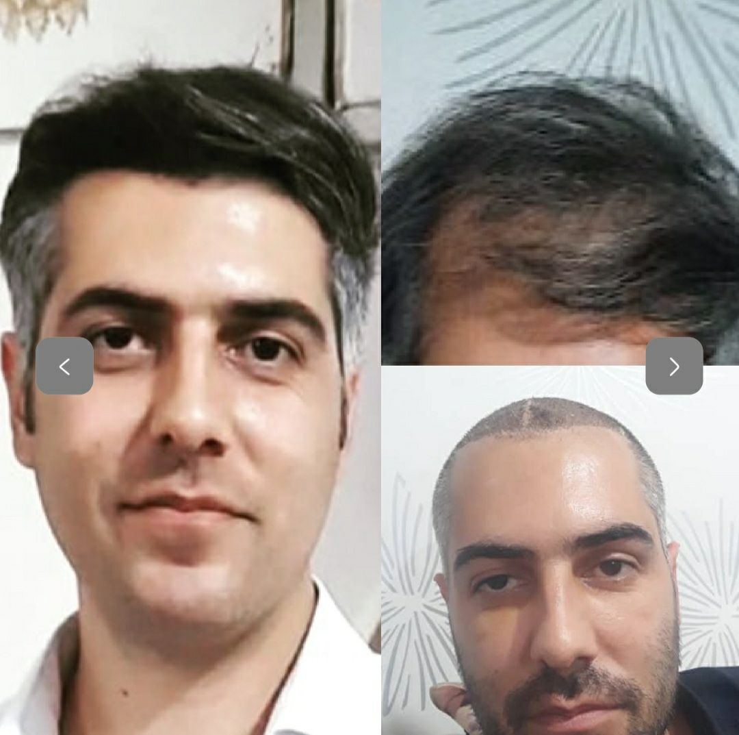 کاشت مو طبیعی در کلینیک زیبایی وانیل سنندج-مشاغل ممتاز