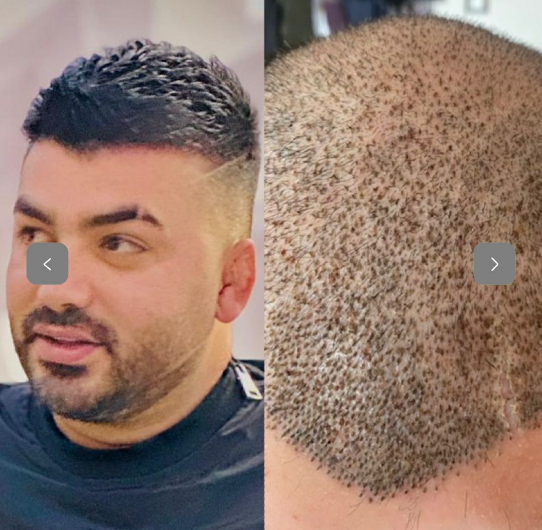کاشت مو و کاشت ابرو طبیعی در کلینیک زیبایی وانیل سنندج-مشاغل ممتاز