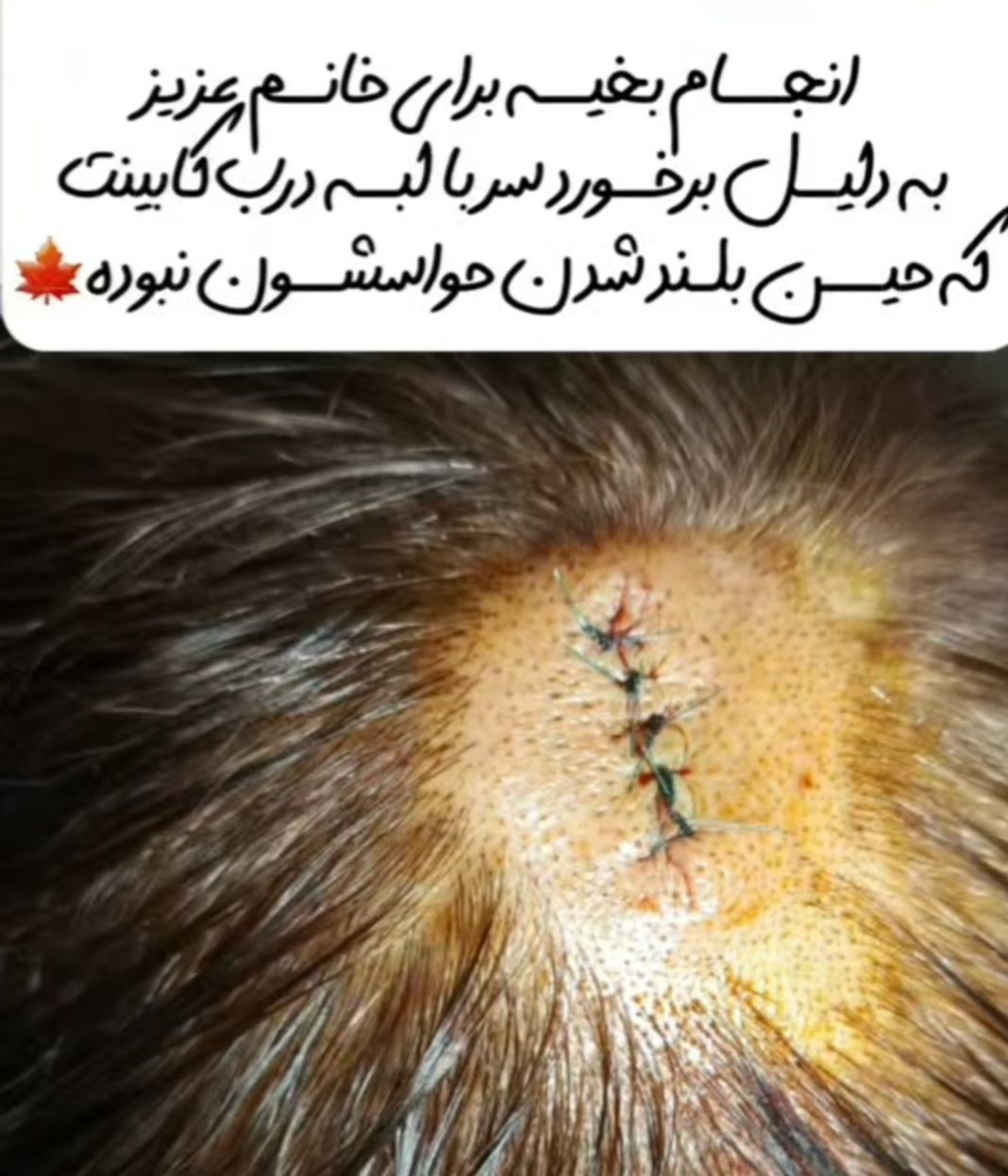 پانسمان تخصصی زخم توسط پرستار مشاوره و خدمات پرستاری حسینی در گرگان – مشاغل ممتاز
