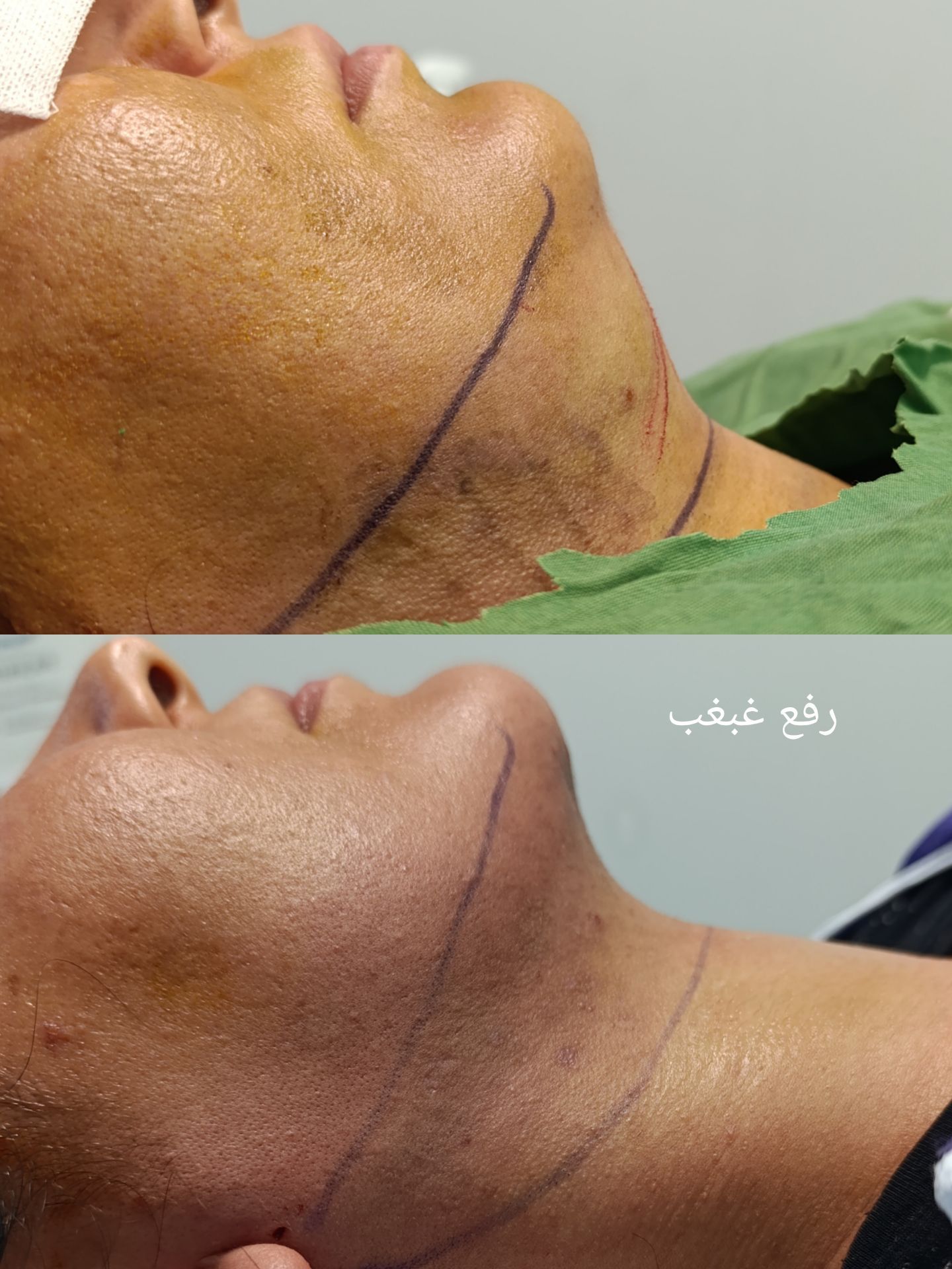 بوکال فت برای فرم دهی صورت در کلینیک زیبایی دکتر امیریان-مشاغل ممتاز