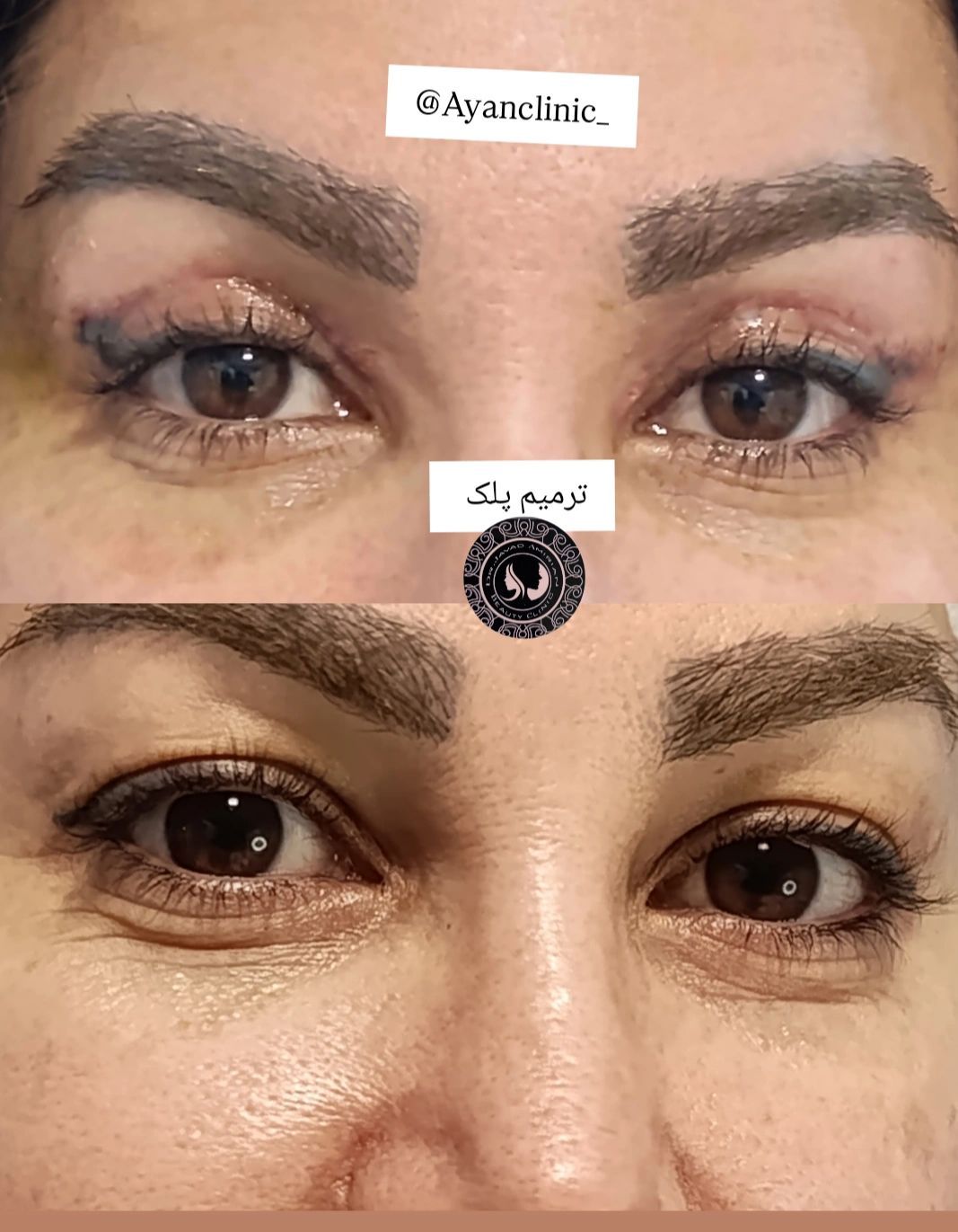 قبل بعد بلفارو کلینیک زیبایی دکتر امیریان در شیراز-مشاغل ممتاز