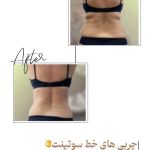 لاغری موضعی بانوان غزاله نوروزی همدان