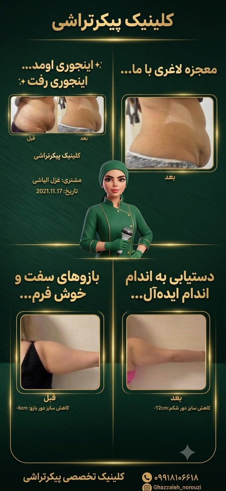 نتیجه لاغری موضعی شکم و پهلو بانوان در همدان توسط غزاله نوروزی-مشاغل ممتاز