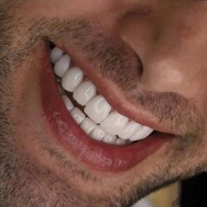 ساخت دندان متحرک رضایی یزد با کیفیت بالا و قالب‌گیری دقیق -مشاغل ممتاز