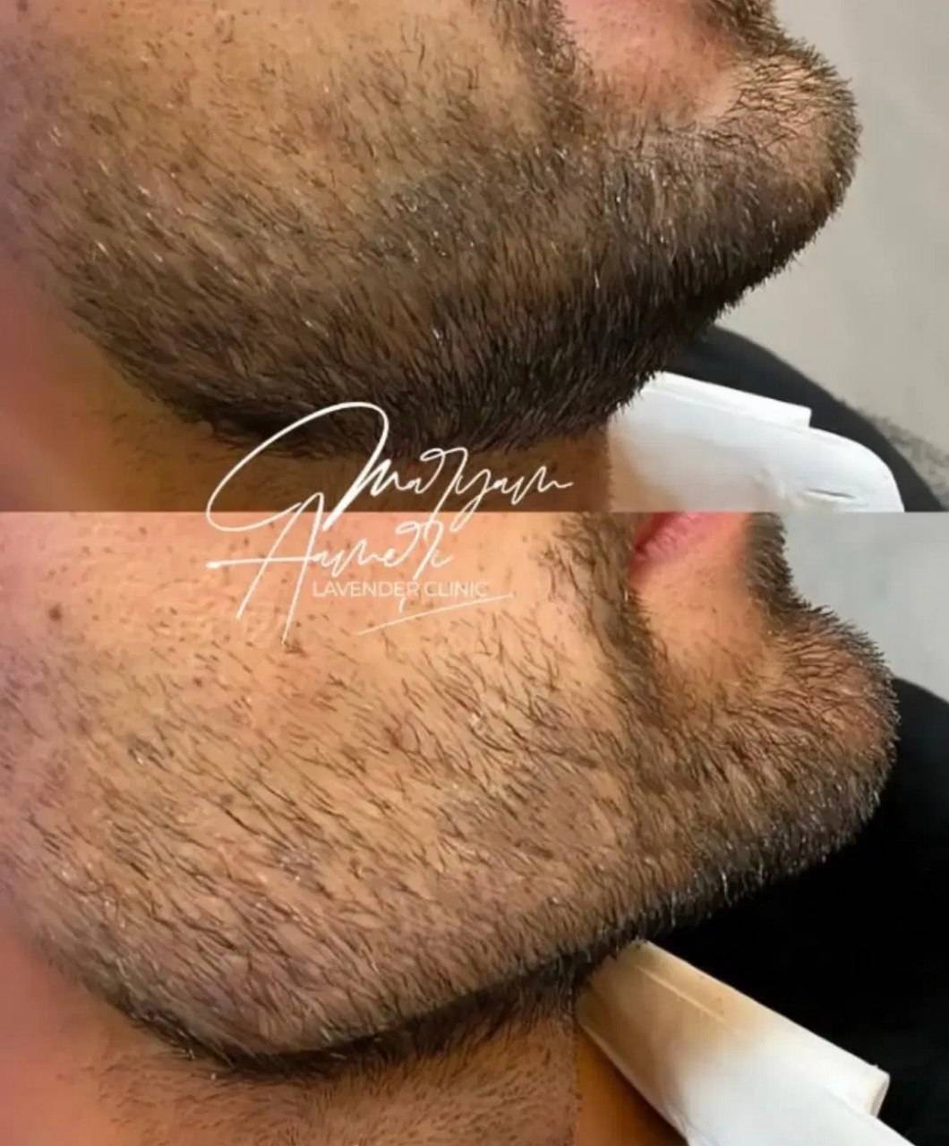 زاویه سازی صورت با فیلر در کلینیک زیبایی لوندر ساری -مشاغل ممتاز