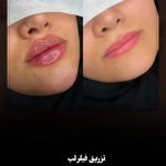 کلینیک زیبایی کاشت مو و ابرو لوندر در ساری