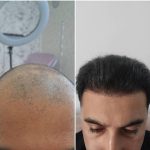 کلینیک کاشت مو آقای رضاپور در بابل