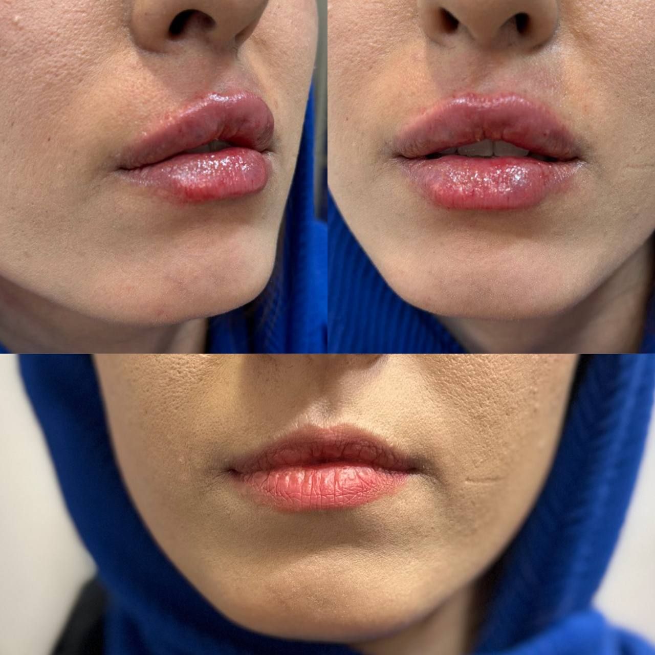 ژل لب در درمانگاه پوست و مو آدینا در قم-مشاغل ممتاز