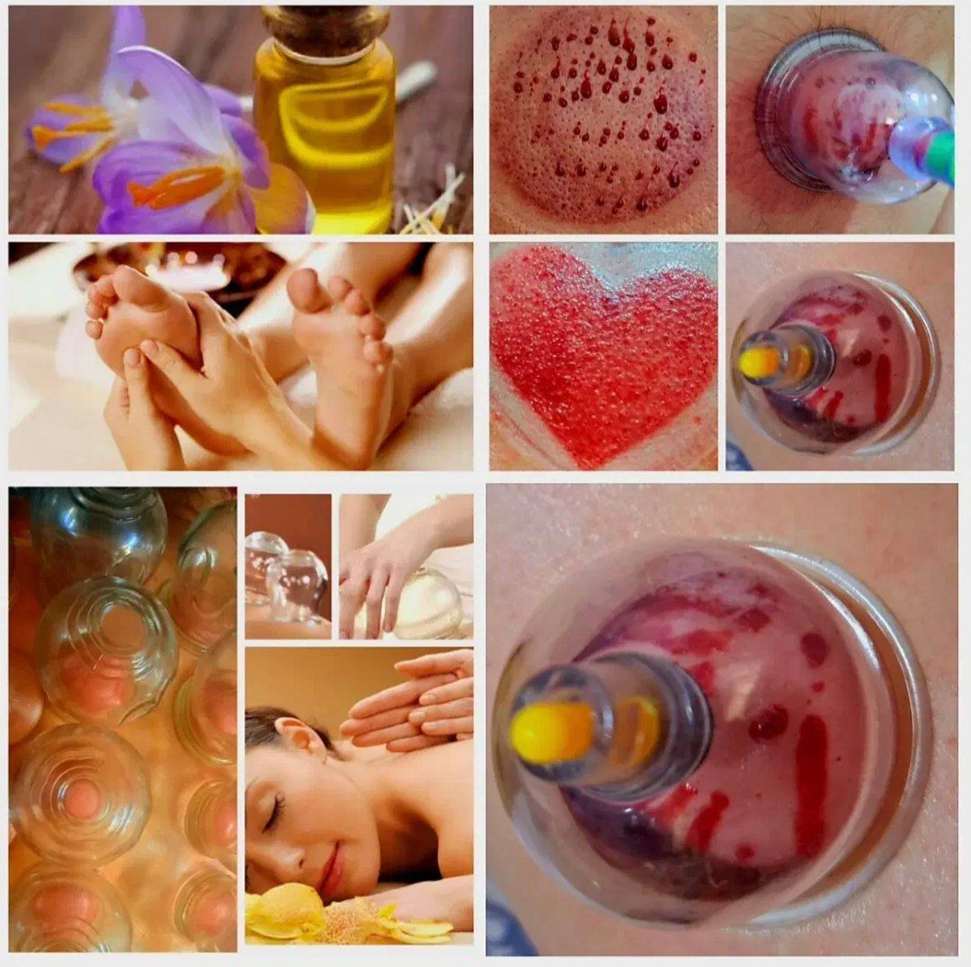انجام بادکش درمانی حرفه‌ای برای رفع درد عضلات در مرکز طب سنتی مهین قلی زاده-مشاغل ممتاز
