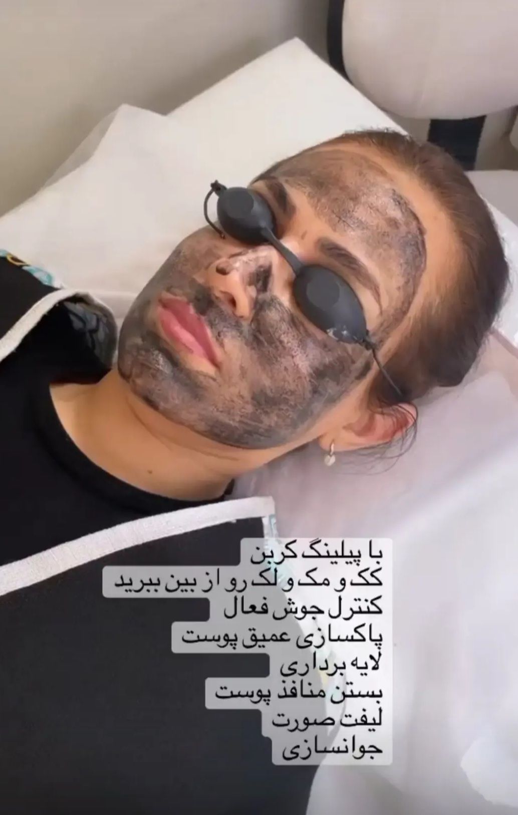 پیلینگ با کربن زهرا انصاری اصفهان-مشاغل ممتاز