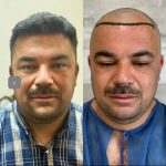 کلینیک کاشت مو و ابرو محرمی تبریز