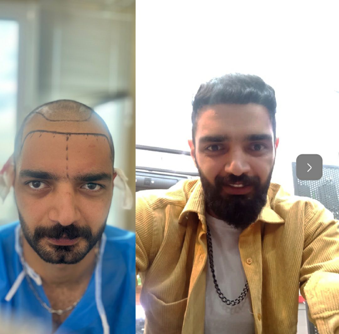 کاشت طبیعی مو در تبریز | کلینیک تخصصی کاشت مو و ابرو محرمی-مشاغل ممتاز